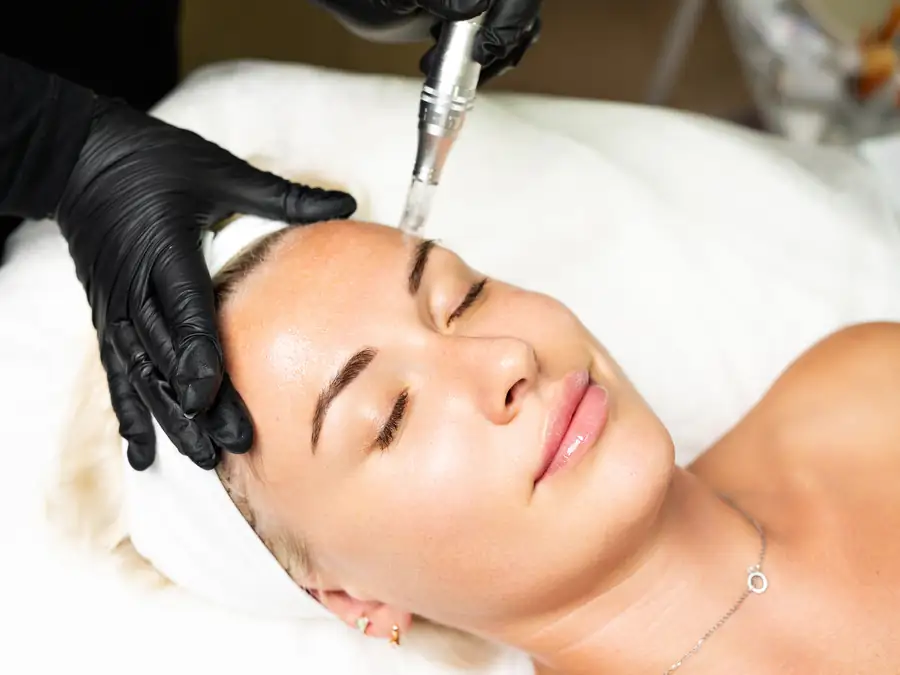 Microneedling facial treatment on a client's forehead