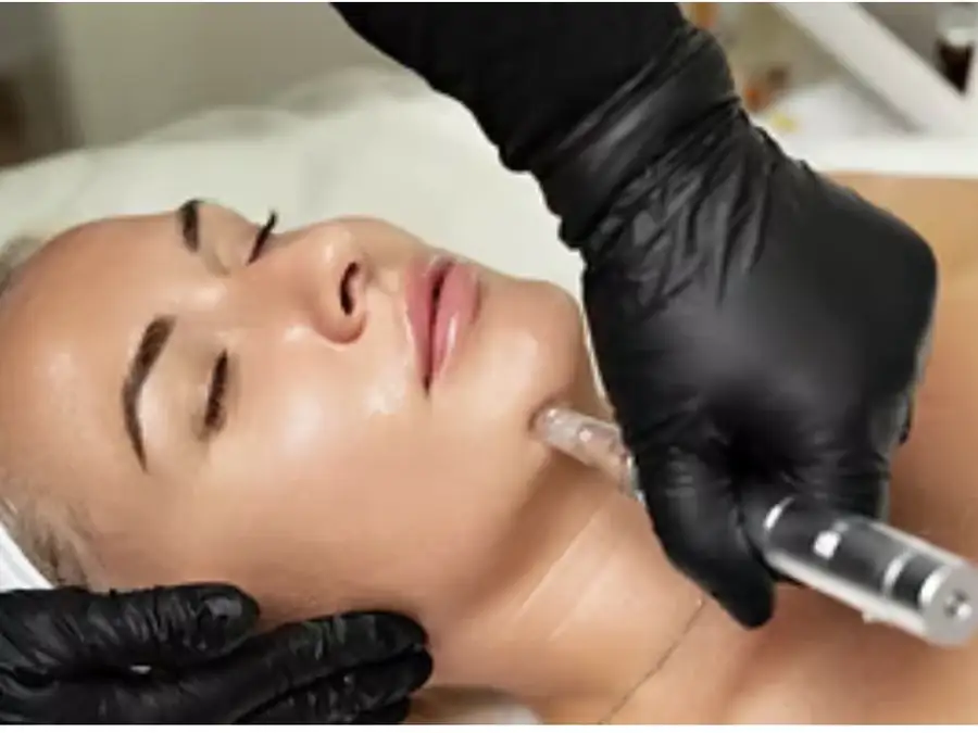 Microneedling treatment along a client's jawline Microneedling treatment along a client's jawline